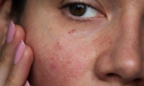 A woman looks at red skin on her cheeks.